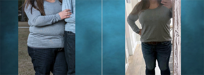 Gastric Sleeve Before and after