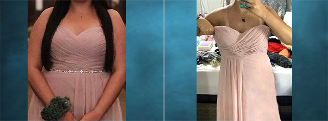 Gastric Sleeve befor and after photos