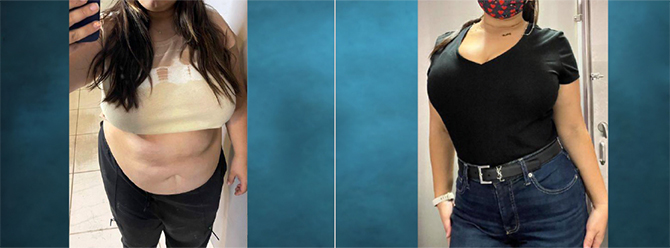 Gastric Sleeve before and after