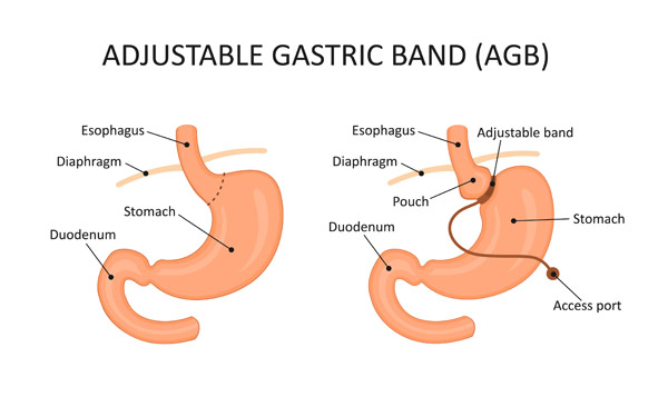 Miami Gastric Band Surgery